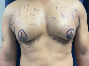 A person's bare chest with gynecomastia and pre-surgical markings drawn in purple ink.