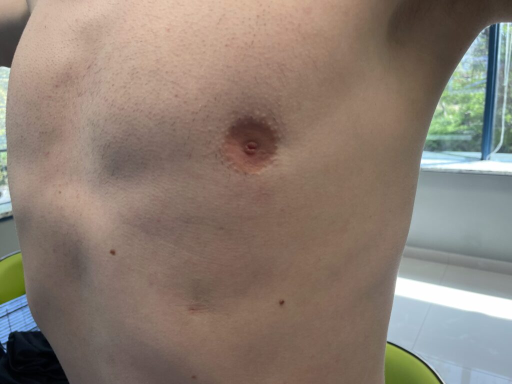 A close-up of a person's chest showing a single, slightly indented and raised area around the nipple. Natural light is coming from a nearby window.