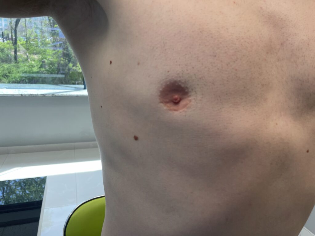A close-up of a person's bare chest showing a slightly indented areola, with two small moles visible nearby. Natural light comes through windows in the background.