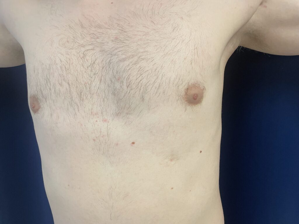 A close-up of a person's bare, hair-covered chest and abdomen against a blue background, with arms raised and visible small red spots on the skin.