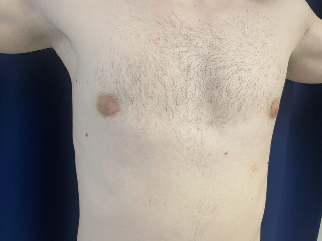 A shirtless person with light skin and sparse chest hair is standing with arms slightly raised, with some small red spots visible on the chest and upper abdomen.