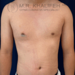Frontal view of male chest after bilateral gynecomastia surgery with visibly flatter contours