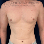 after front gyno