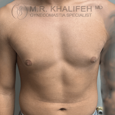 after front puffy nipple