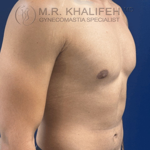 after half side view puffy nipple