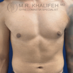 before front puffy nipple