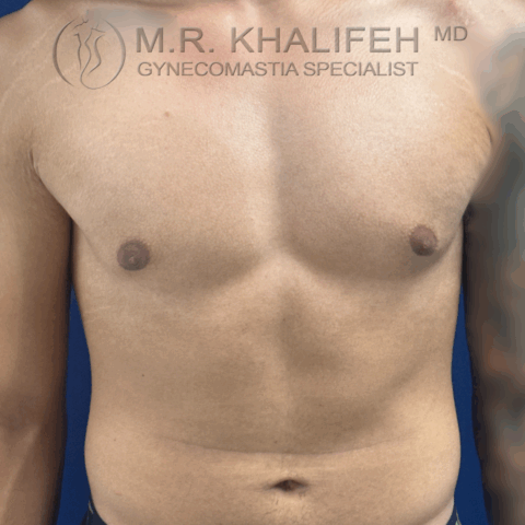 before front puffy nipple