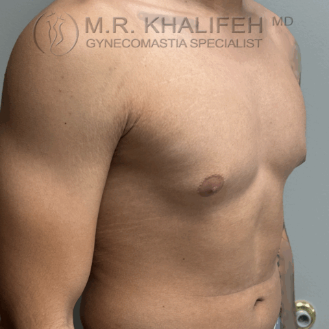 before half side view puffy nipple