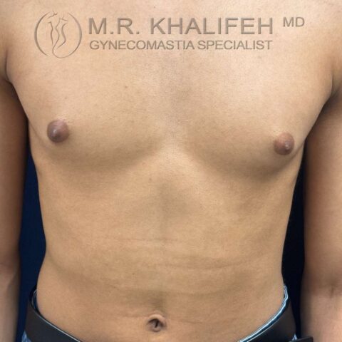 before front view puffy nipple