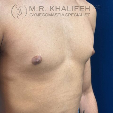 before 3/4 side left view puffy nipple