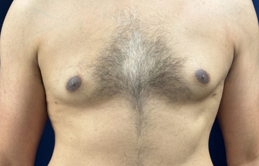 A shirtless person with visible chest hair standing against a dark blue background, showing the upper torso from the shoulders to the abdomen.