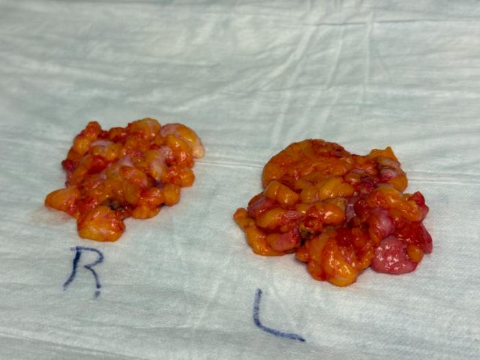 Two separate clusters of yellow-red tissue, labeled "R" and "L," are placed on a medical drape, likely indicating left and right samples for comparison.