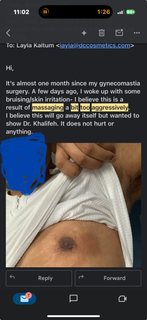 Screenshot of a mobile email. The email reads:
“Hi,
It’s almost one month since my gynecomastia surgery. A few days ago, I woke up with some bruising/skin irritation – I believe this is a result of massaging a bit too aggressively. I believe this will go away itself but wanted to show Dr. Khalifeh. It does not hurt or anything.”
Below the message is a photo of a person lifting their white shirt to show their chest after surgery. The person’s face is obscured with a blue scribble. The chest shows visible bruising and skin discoloration around the nipple area, likely from recent massage following gynecomastia surgery.