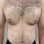 Front view after gynecomastia surgery with reduced skin excess