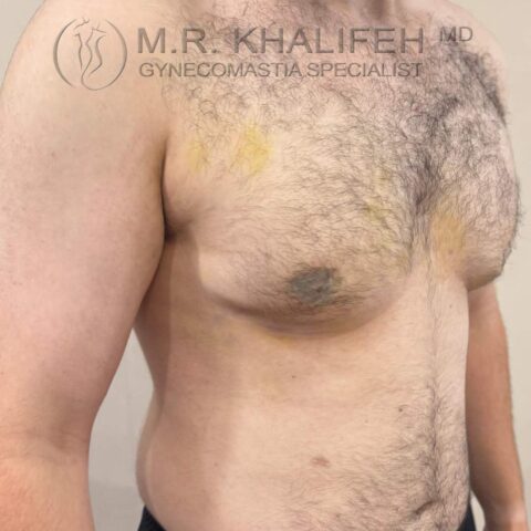 Three-quarter right view after gynecomastia surgery with reduced skin excess