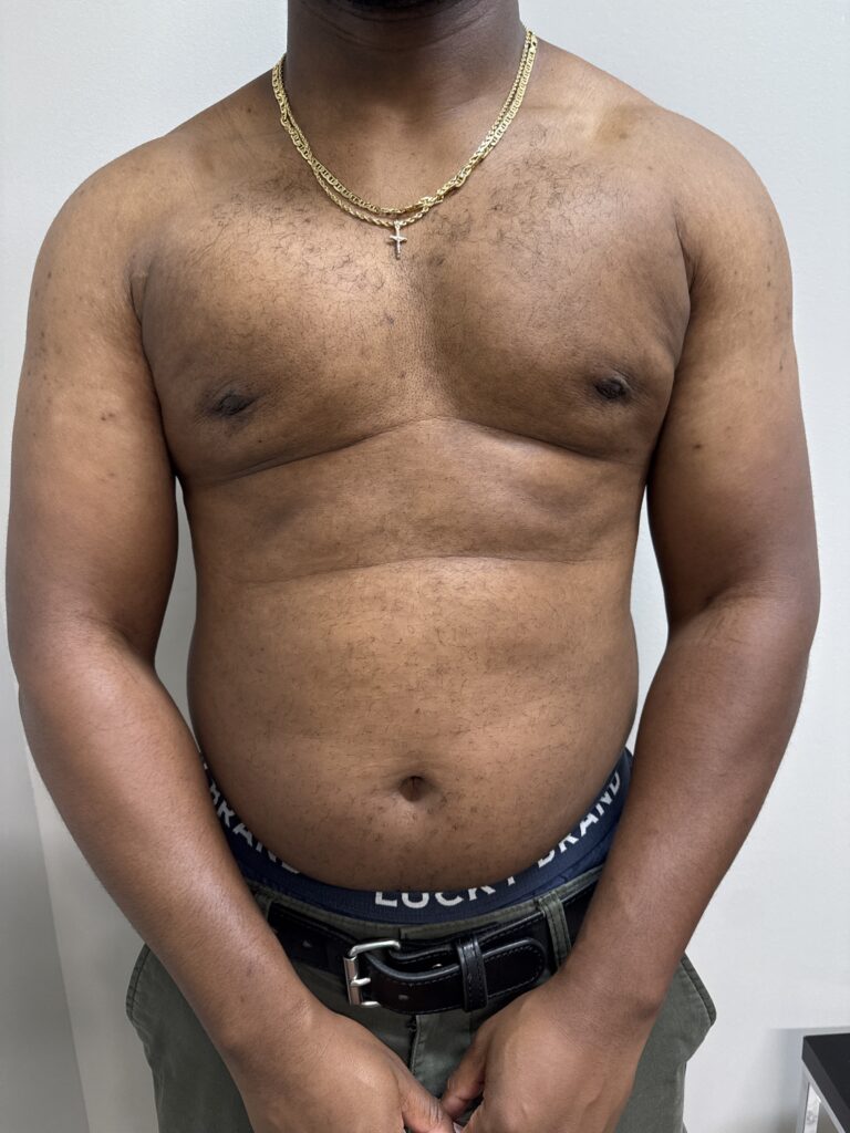 This image shows contour irregularities after gynecomastia surgery that are typical with flexion of muscle.