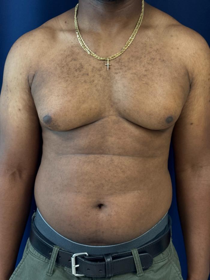 A person with medium brown skin tone and visible gynecomastia, wearing a gold necklace and green pants, standing against a dark blue background.
