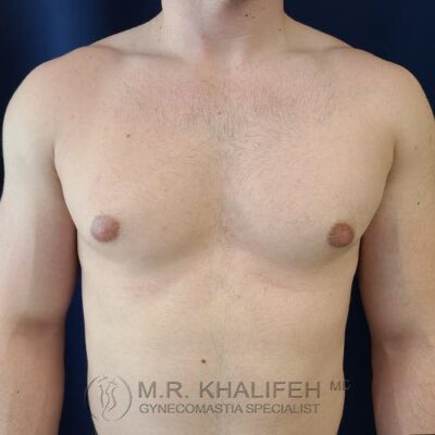 A shirtless adult male with visible enlarged breast tissue, possibly gynecomastia, standing against a dark background.