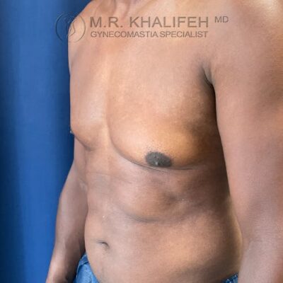 A shirtless man stands sideways against a blue background, showing his chest and abdomen. Text overlay reads: "M.R. Khalifeh MD, Gynecomastia Specialist.