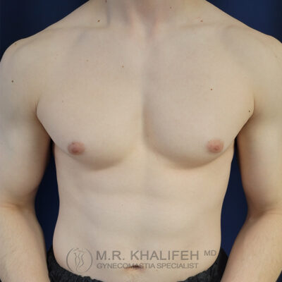 A shirtless person stands against a dark background, showing a bare chest and upper abdomen. The text "M.R. Khalifeh MD Gynecomastia Specialist" is visible at the bottom.