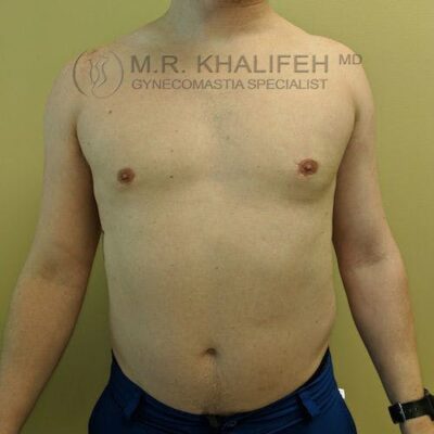 A shirtless man stands facing forward against a light-colored background. Text above identifies "M.R. Khalifeh MD, Gynecomastia Specialist.