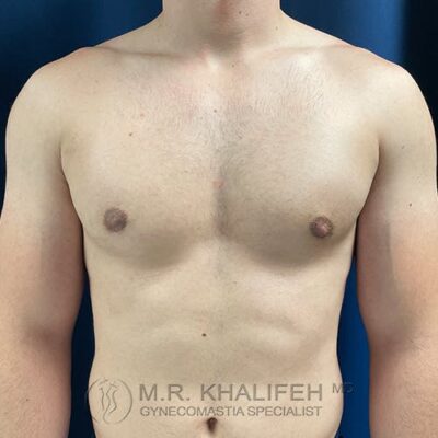 A shirtless male torso shown from the front against a blue background, displaying a flat chest with minimal body hair. Text at the bottom reads “M.R. Khalifeh MD, Gynecomastia Specialist.”.