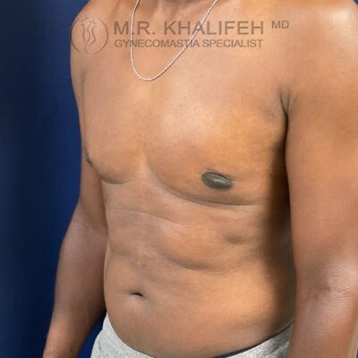 A man’s bare chest and abdomen are shown from the side against a blue background. The photo includes the watermark "MR. KHALIFEH MD GYNECOMASTIA SPECIALIST.