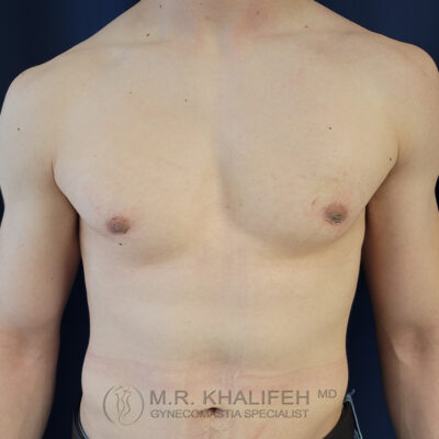 Bare chest of an adult male against a dark background, with slight enlargement of breast tissue visible. Text at the bottom reads "M.R. Khalifeh MD Gynecomastia Specialist.