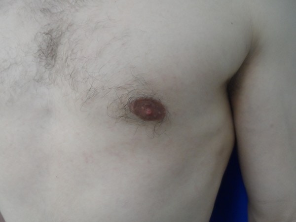 Close-up of a person's bare chest showing an enlarged, swollen, and reddish nipple with surrounding hair.