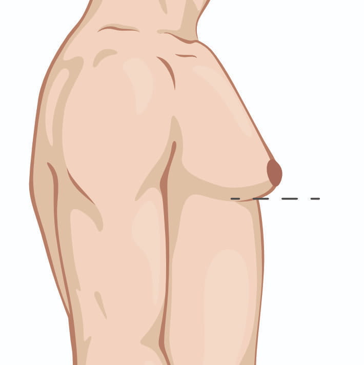 Medical illustration showing a side view of a woman's torso with a dotted line indicating the position of the nipple in relation to the lower breast contour.