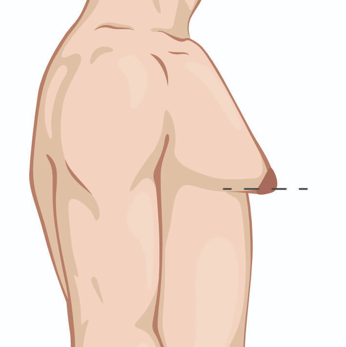 Illustration of a person's torso from the side, showing a breast with the nipple below a dashed horizontal line.