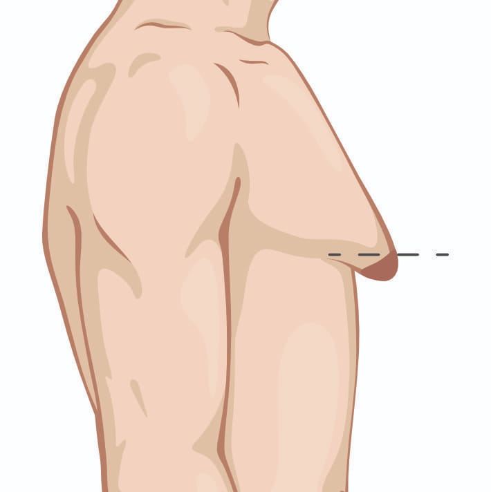 Illustration of a person's chest from the side, showing a drooping nipple and sagging breast tissue, with a dashed line indicating the nipple position.