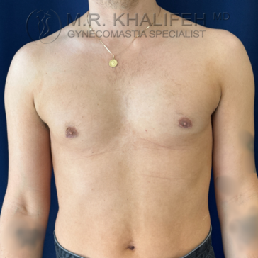Shirtless person standing against a dark blue background, wearing a necklace. The chest appears post-surgical with faint scars below the nipples.