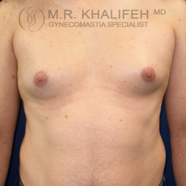 A shirtless person with visible gynecomastia is standing against a dark background. The image includes the text “M.R. Khalifeh MD Gynecomastia Specialist” at the top.
