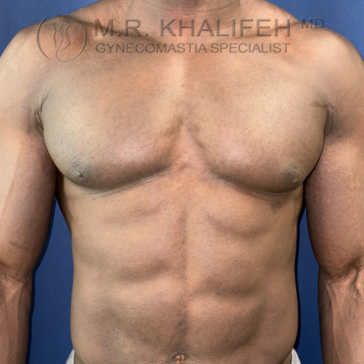 A shirtless male torso is shown against a blue background, displaying muscle definition and mild gynecomastia. Text at the top reads "M.R. Khalifeh MD Gynecomastia Specialist.