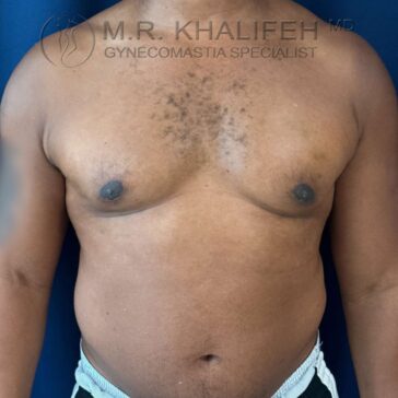 A person with visible gynecomastia stands against a blue background. Text at the top reads, "M.R. Khalifeh MD Gynecomastia Specialist.