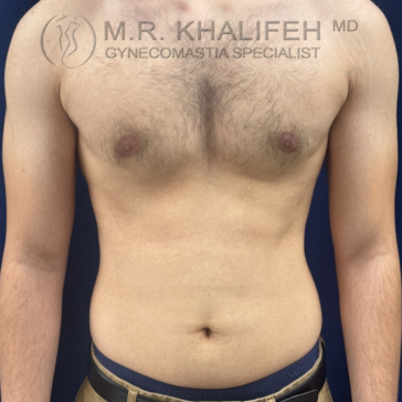 A shirtless male torso is shown from the shoulders to the waist against a dark background, with text identifying a gynecomastia specialist.