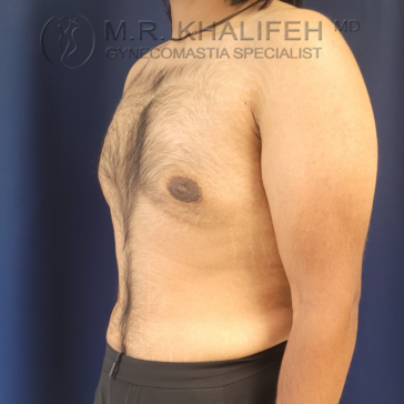 A person with visible chest asymmetry and gynecomastia stands shirtless in profile against a dark background. Text at top reads “M.R. Khalifeh MD Gynecomastia Specialist.”.