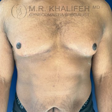 A man's bare chest after gynecomastia surgery, showing flat contours and visible scars below the nipples.
