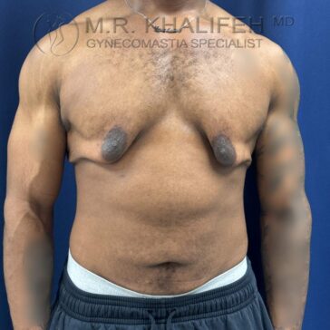 A shirtless man with visible gynecomastia stands against a blue background, wearing gray sweatpants. The top of the image is labeled with a doctor's name and specialty.