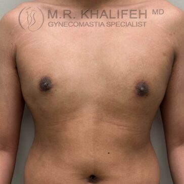 A person’s bare chest and upper abdomen are shown, facing forward, with the logo and text "M.R. Khalifeh MD Gynecomastia Specialist" at the top.