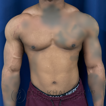 A shirtless person stands against a blue backdrop, showing a muscular torso and arms, with visible chest asymmetry.
