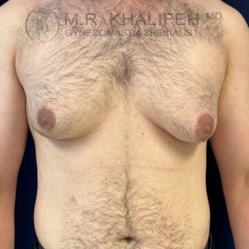 A shirtless adult male torso with visible gynecomastia, showing enlarged breast tissue beneath the nipples.