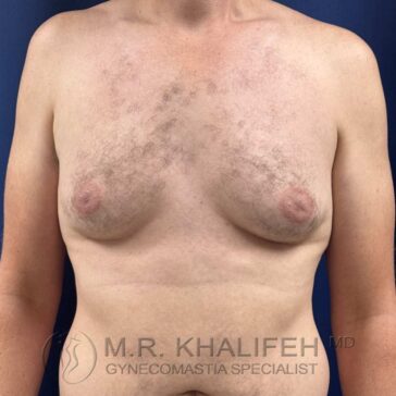 A person with visible gynecomastia, showing enlarged breast tissue on the chest, standing against a blue background.