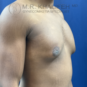 A close-up, side view of a man's bare chest with visible gynecomastia against a blue background. Text on the image reads: "M.R. Khalifeh MD, Gynecomastia Specialist.