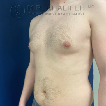 A shirtless male torso is shown from the side against a blue background, displaying mild gynecomastia. Text reads “M.R. Khalifeh MD, Gynecomastia Specialist” at the top.