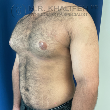 Adult male torso shown from the side, displaying visible gynecomastia on the left side of the chest. Blue background and doctor’s watermark are visible.