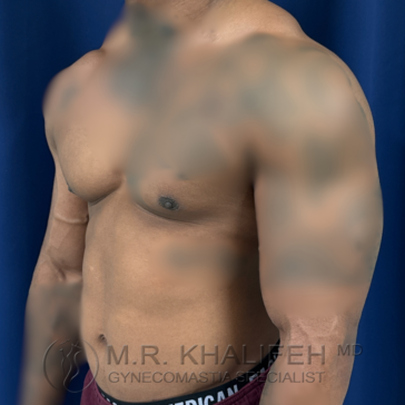 Shirtless person standing at an angle against a dark blue background, with visible chest and arm muscles; watermark reads "M.R. Khalifeh MD Gynecomastia Specialist.