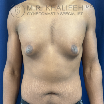A person with gynecomastia and visible stretch marks on the abdomen stands against a blue background with clinic branding at the top of the image.
