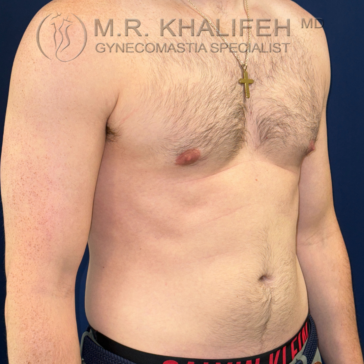 A shirtless man with mild gynecomastia stands against a blue background, wearing a gold necklace with a cross pendant and dark waistband underwear. Text overlay names a gynecomastia specialist.